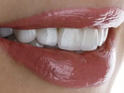 dentalveneers.webp